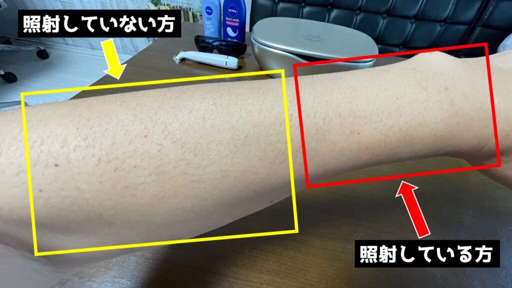 ケノンで脱毛している左腕の右半分と照射していない左半分