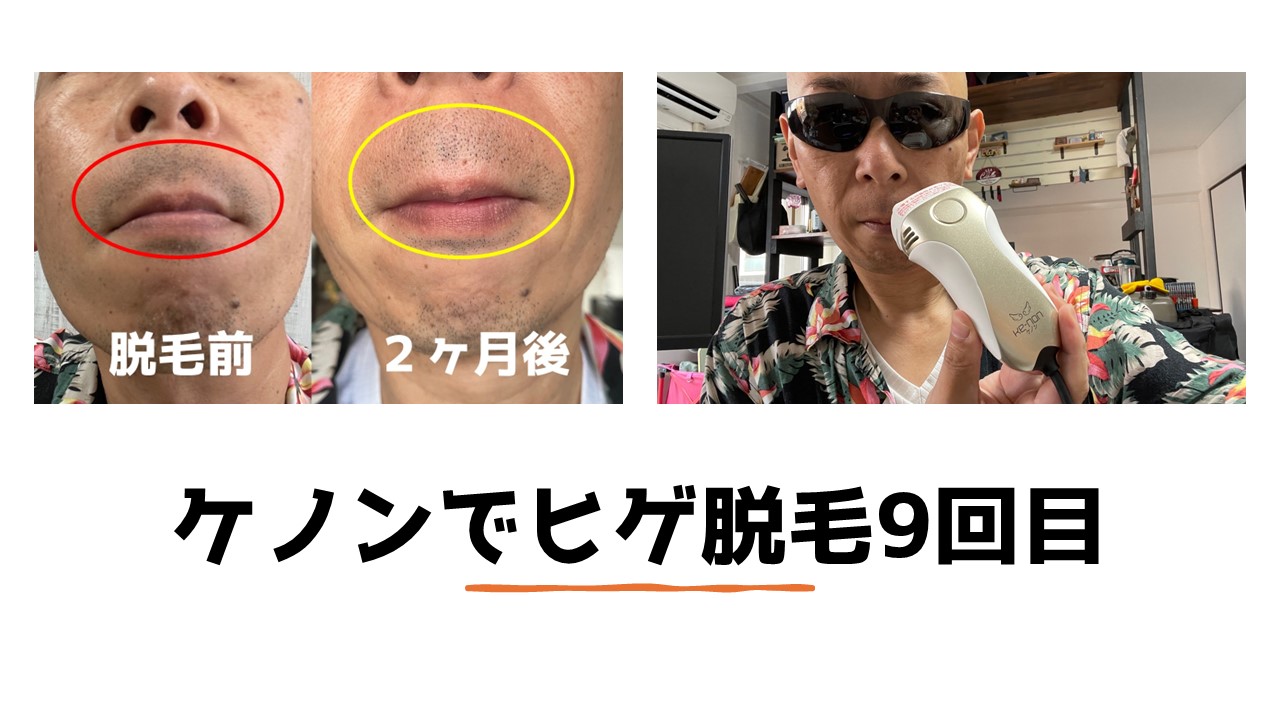ケノンでヒゲ脱毛開始してから2ヶ月経過して何か変化はあったのか 