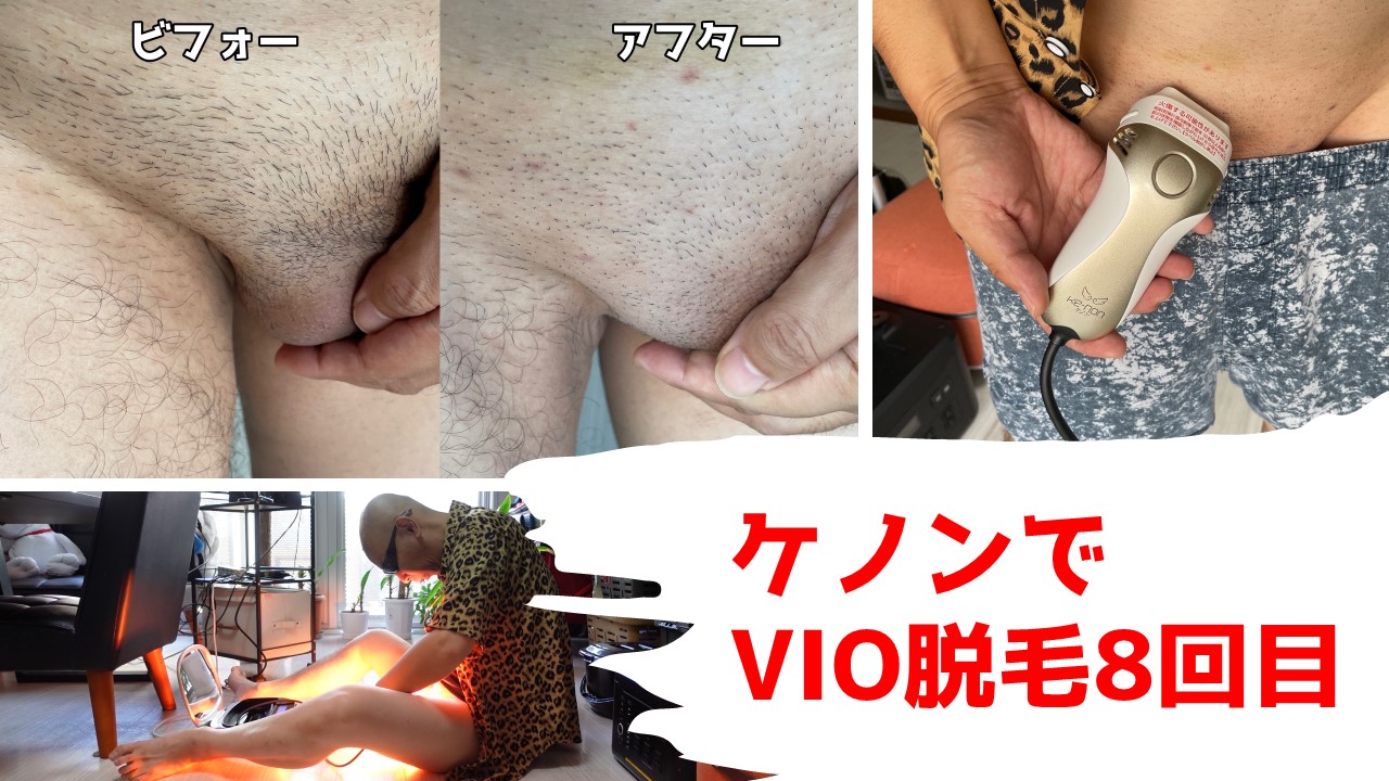 ケノンでVIO脱毛8回目