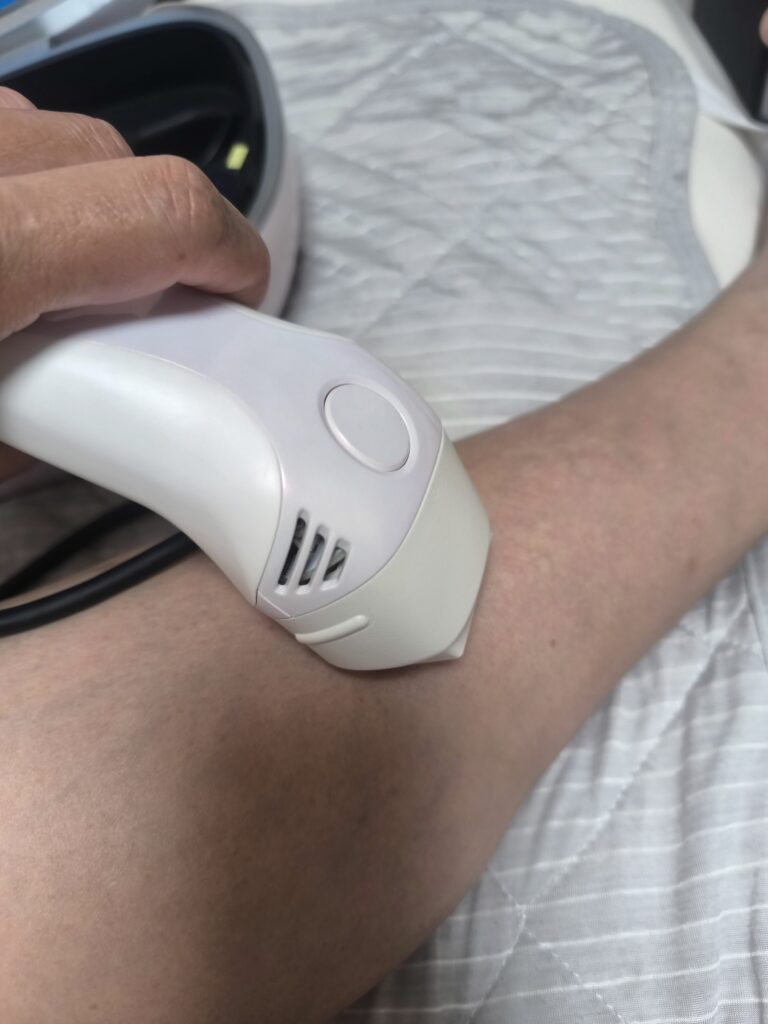 ケノンで足の脱毛