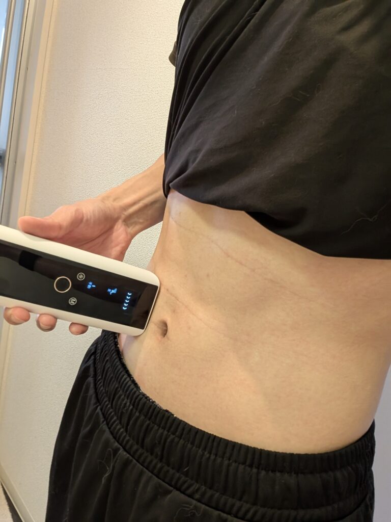 YOYIFUNでお腹の脱毛